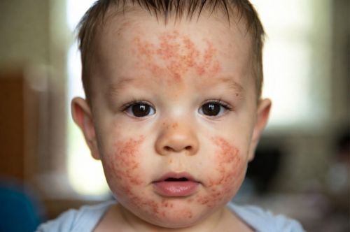 Атопический дерматит